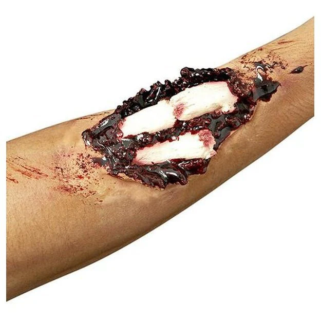 Compound Fracture